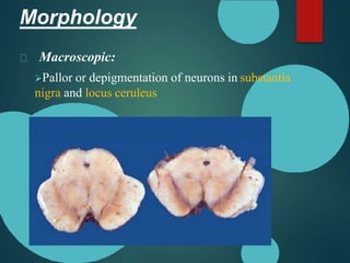 Morphology
Macroscopic:
Pallor or depigmentation of neurons in substantia
nigra and locus ceruleus
 