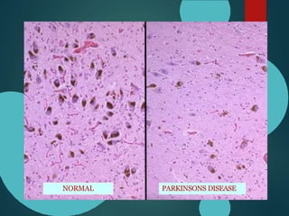 NORMAL PARKINSONS DISEASE
 