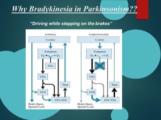 Why Bradykinesia in Parkinsonism??
“Driving while stepping on the brakes”
 