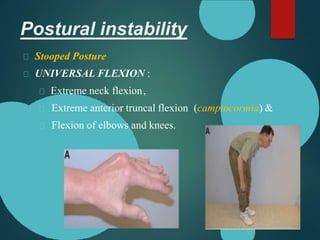 Postural instability
Stooped Posture
UNIVERSAL FLEXION :
Extreme neck flexion,
Extreme anterior truncal flexion (camptocormia) &
Flexion of elbows and knees.
 