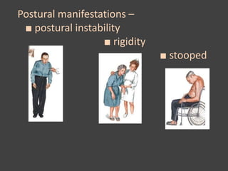 Postural manifestations –
■ postural instability
■ rigidity
■ stooped
 