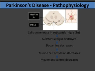 Cells degenerate in substantia nigra (Sn)
Substantia nigra destroyed
Dopamine decreases
Muscle cell activation decreases
Movement control decreases
Parkinson’s Disease - Pathophysiology
Healthy
Sn
PD Sn
 