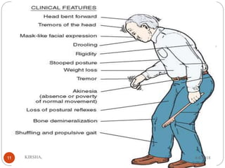 Cardinal
Features
Motor
Symptoms
Autonomic
Symptoms
Mental
Status
Changes
CLINICAL FEATURES
4/4/2018KIRSHA,11
 