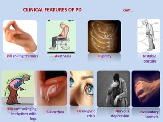 CLINICAL FEATURES OF PD cont..
Pill rolling tremors Akathesia Rigidity Instable
posture
No arm swinging
In rhythm with
legs
Sialorrhea Oculogyric
crisis
Nervous
depression
Involuntary
tremors
 