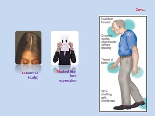 Masked like
face
expression
Seborrhea
(scalp)
Cont…
 