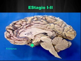 EStagio I-II 
Ñ Sintomas 
 