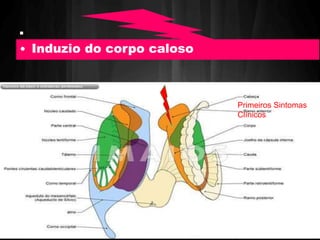 . 
• Induzio do corpo caloso 
Primeiros Sintomas 
Clínicos 
 