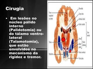 Cirugia 
• Em lesões no 
núcleo pálido 
interno 
(Palidotomia) ou 
do tálamo ventro-lateral 
(Talamotomia), 
que estão 
envolvidos no 
mecanismo da 
rigidez e tremor. 
 