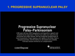 1. PROGRESSIVE SUPRANUCLEAR PALSY
 