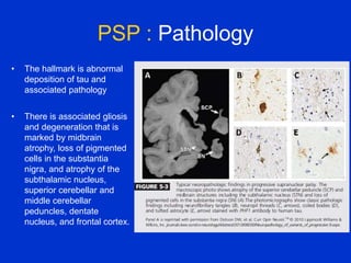 PSP : Pathology
• The hallmark is abnormal
deposition of tau and
associated pathology
• There is associated gliosis
and degeneration that is
marked by midbrain
atrophy, loss of pigmented
cells in the substantia
nigra, and atrophy of the
subthalamic nucleus,
superior cerebellar and
middle cerebellar
peduncles, dentate
nucleus, and frontal cortex.
 