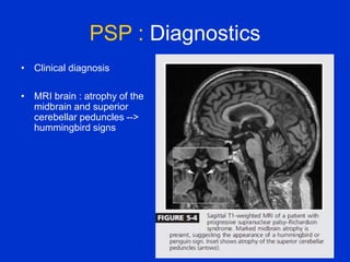PSP : Diagnostics
• Clinical diagnosis
• MRI brain : atrophy of the
midbrain and superior
cerebellar peduncles -->
hummingbird signs
 