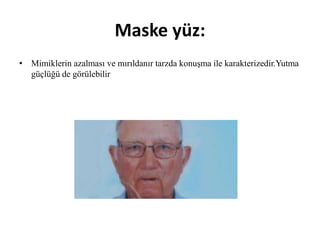 Maske yüz:
• Mimiklerin azalması ve mırıldanır tarzda konuşma ile karakterizedir.Yutma
güçlüğü de görülebilir
 