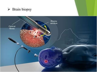  Brain biopsy
 