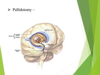  Pallidotomy –
 