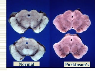 Neuropathology Normal Parkinson’s 