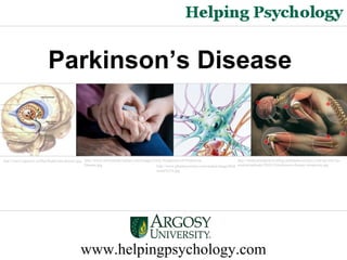 www.helpingpsychology.com
Parkinson’s Disease
http://www.topnews.in/files/Parkinson-disease.jpg http://www.onlinemedicinetips.com/images/Early-Symptoms-Of-Parkinson-
Disease.jpg http://www.pharmacytimes.com/media/image/Park
inson%27s.jpg
http://medicalmalpracticeblog.nashandassociates.com/wp-site/wp-
content/uploads/2010/10/parkinson-disease-symptoms.jpg
 