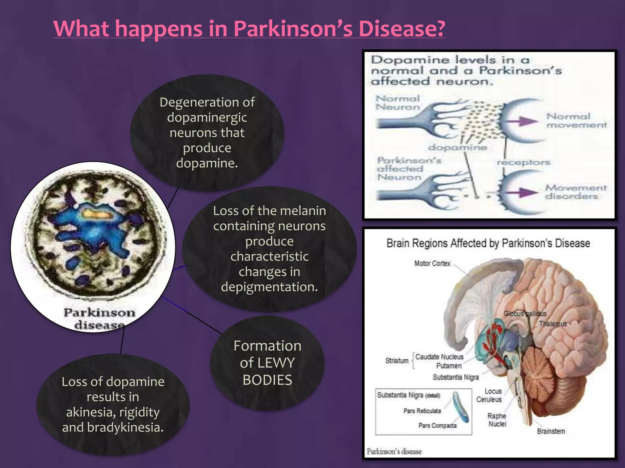 Parkinson's Disease | PPTX
