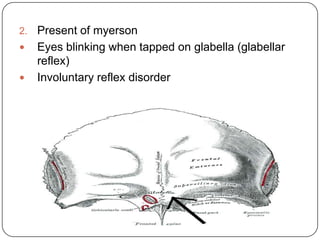 2. Present of myerson
 Eyes blinking when tapped on glabella (glabellar
reflex)
 Involuntary reflex disorder
 