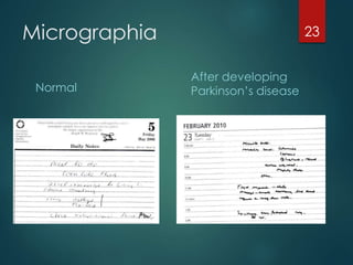 Micrographia Examples Parkinson’s disease | PPTX
