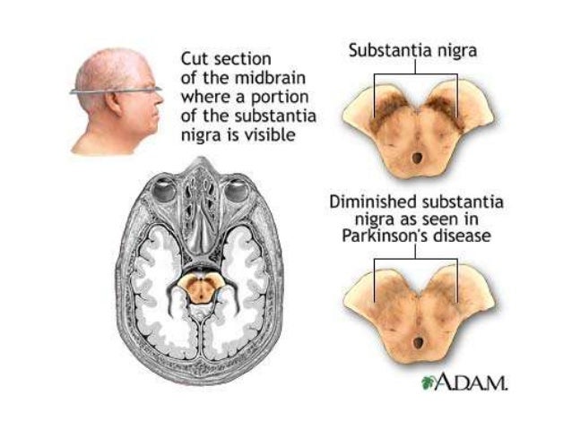Parkinson’s disease