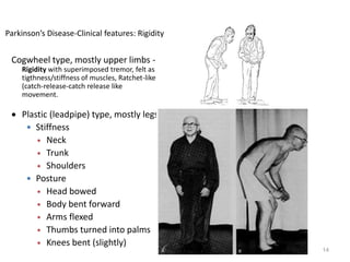 14
Parkinson’s Disease-Clinical features: Rigidity
Cogwheel type, mostly upper limbs -
Rigidity with superimposed tremor, felt as
tigthness/stiffness of muscles, Ratchet-like
(catch-release-catch release like
movement.
 Plastic (leadpipe) type, mostly legs
 Stiffness
 Neck
 Trunk
 Shoulders
 Posture
 Head bowed
 Body bent forward
 Arms flexed
 Thumbs turned into palms
 Knees bent (slightly)
 