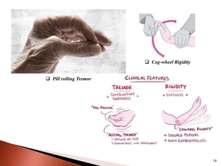 18
 Pill rolling Tremor
 Cog-wheel Rigidity
 