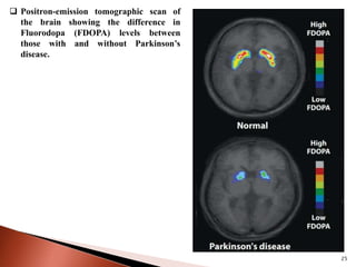 25
 Positron-emission tomographic scan of
the brain showing the difference in
Fluorodopa (FDOPA) levels between
those with and without Parkinson’s
disease.
 