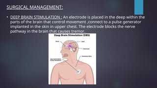 SURGICAL MANAGEMENT:
• DEEP BRAIN STIMULATION : An electrode is placed in the deep within the
parts of the brain that control movement ,connect to a pulse generator
implanted in the skin in upper chest. The electrode blocks the nerve
pathway in the brain that causes tremor.
 