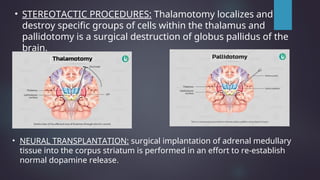 • STEREOTACTIC PROCEDURES: Thalamotomy localizes and
destroy specific groups of cells within the thalamus and
pallidotomy is a surgical destruction of globus pallidus of the
brain.
• NEURAL TRANSPLANTATION: surgical implantation of adrenal medullary
tissue into the corpus striatum is performed in an effort to re-establish
normal dopamine release.
 