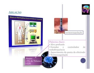 ABLAÇÃO




                                          termocoagulação



                           Palavras chave:
                           • Alvo profundo
                           • Gerador    e    controlador    de
                           radiofrequência
                           • Aquecimento da ponta do eléctrodo
                           • Termocoagulação
          Neuro:
          • VL do Tálamo
          • GPi
 