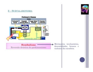 3 – SUBTALAMOTOMIA




            Hemibalismo                Movimentos involuntários,
                                       descontrolados, bruscos e
  Reversão drástica do parkinsonismo   violentos dos membros.
 