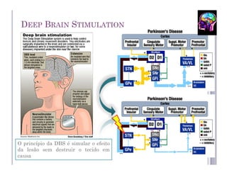 DEEP BRAIN STIMULATION




O princípio da DBS é simular o efeito   20
da lesão sem destruir o tecido em
causa
 