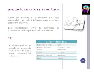 APLICAÇÃO DO ARCO ESTEREOTÁXICO

Ainda na enfermaria é colocado um arco
estereotáxico, paralelo à linha comissura anterior –
comissura posterior.

Este instrumento serve de referência              às
coordenadas usadas para a localização do alvo


TC
                                        Caracteristicas da TC
                             Espessura do corte    2mm
 O doente realiza um
 estudo de tomografia        Caractristicas dos    Contiguos e não
                             cortes                sobrepostos
 computorizada com o
                             Matriz                521*521
 arco     estereotáxico
 colocado                    Geometria do pixel    Quadrado
                             FOV                   280mm
                                                                     23
 
