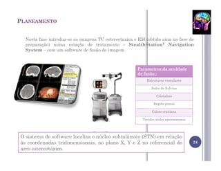 PLANEAMENTO


  Nesta fase introduz-se as imagens TC estereotaxica e RM (obtida aina na fase de
  preparação) numa estação de tratamento – StealthStation® Navigation
  System – com um software de fusão de imagem



                                                      Parametros da acuidade
                                                      de fusão :
                                                           Estruturas vasculares

                                                              Sulco de Sylvius

                                                                 Cristalino

                                                               Região pineal

                                                              Calote craniana

                                                         Tecidos moles epicraneanos




O sistema de software localiza o núcleo subtalâmico (STN) em relação
às coordenadas tridimensionais, no plano X, Y e Z no referencial do                   24
arco estereotáxico.
 