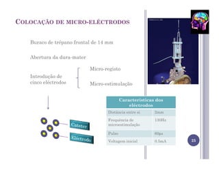 COLOCAÇÃO DE MICRO-ELÉCTRODOS


   Buraco de trépano frontal de 14 mm


   Abertura da dura-mater

                            Micro-registo
   Introdução de
   cinco eléctrodos         Micro-estimulação


                                           Caracteristicas dos
                                               eléctrodos
                                   Distância entre si     2mm

                                   Frequência de          130Hz
                                   microestimulação

                                   Pulso                  60µs
                                   Voltagem inicial       0.5mA   25
 