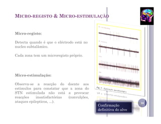 MICRO-REGISTO & MICRO-ESTIMULAÇÃO


Micro-registo:

Detecta quando é que o eléctrodo está no
nucleo subtalâmico.

Cada zona tem um microregisto próprio.




Micro-estimulação:

Observa-se a reacção do doente aos
estimulos para constatar que a zona do
STN estimulada não está a provocar
reacções    insatisfactórias (convulções,
ataques epilepticos, ...).                                       26
                                            Confirmação
                                            definitiva do alvo
 