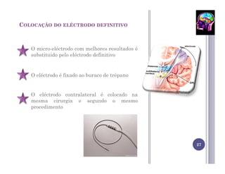 COLOCAÇÃO   DO ELÉCTRODO DEFINITIVO




   O micro-eléctrodo com melhores resultados é
   substituido pelo eléctrodo definitivo


   O eléctrodo é fixado ao buraco de trépano


   O eléctrodo contralateral é colocado na
   mesma cirurgia e segundo o mesmo
   procedimento




                                                 27
 