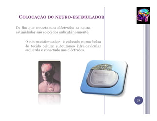 COLOCAÇÃO DO NEURO-ESTIMULADOR

Os fios que conectam os eléctrodos ao neuro-
estimulador são colocados subcutâneamente.

     O neuro-estimulador é colocado numa bolsa
     de tecido celular subcutâneo infra-cavicular
     esquerda e conectado aos eléctrodos.




                                                    28
 