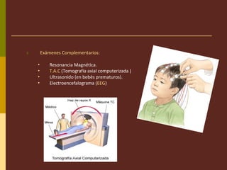 3. Exámenes Complementarios:
• Resonancia Magnética.
• T.A.C (Tomografía axial computerizada )
• Ultrasonido (en bebés prematuros).
• Electroencefalograma (EEG)
 
