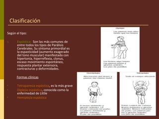 Clasificación
Según el tipo:
1. Espástica: Son las más comunes de
entre todos los tipos de Parálisis
Cerebrales. Su síntoma primordial es
la espasticidad (aumento exagerado
del tono muscular) manifestada con
hipertonía, hiperreflexia, clonus,
escaso movimiento espontáneo,
respuesta plantar extensora,
contracturas y deformidades.
Formas clínicas
• Tetraparesia espástica, es la más grave
• Diplejia espástica, conocida como la
enfermedad de Little
• Hemiplejía espástica
 