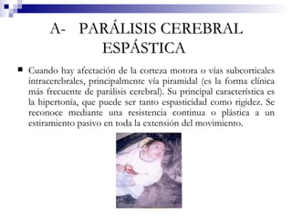 A-  PARÁLISIS CEREBRAL ESPÁSTICA   Cuando hay afectación de la corteza motora o vías subcorticales intracerebrales, principalmente vía piramidal (es la forma clínica más frecuente de parálisis cerebral). Su principal característica es la hipertonía, que puede ser tanto espasticidad como rigidez. Se reconoce mediante una resistencia continua o plástica a un estiramiento pasivo en toda la extensión del movimiento.  