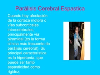 Parálisis Cerebral Espastica
Cuando hay afectación
de la corteza motora o
vías subcorticales
intracerebrales,
principalmente vía
piramidal (es la forma
clínica más frecuente de
parálisis cerebral). Su
principal característica
es la hipertonía, que
puede ser tanto
espasticidad como
rigidez.
 