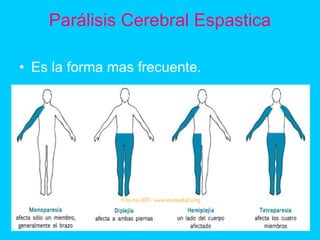 Parálisis Cerebral Espastica
• Es la forma mas frecuente.
 