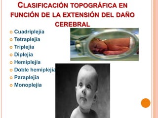 CLASIFICACIÓN TOPOGRÁFICA EN
FUNCIÓN DE LA EXTENSIÓN DEL DAÑO
                 CEREBRAL
 Cuadriplejía
 Tetraplejía

 Triplejía

 Diplejía

 Hemiplejía

 Doble hemiplejía

 Paraplejía

 Monoplejía
 