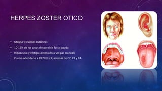 HERPES ZOSTER OTICO

• Otalgia y lesiones cutáneas
• 10-15% de los casos de paralisis facial aguda
• Hipoacusia y vértigo (extensión a VIII par craneal)
• Puede extenderse a PC V,IX y X, además de C2, C3 y C4.

 