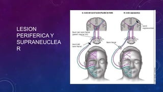 LESION
PERIFERICA Y
SUPRANEUCLEA
R

 