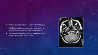 • Parálisis facial recurrente = Valoración radiológica
• Si el Dx se retrasa, consecuencias potenciales de
extensión hacia laberinto oseo y fosa craneal
• Tratamiento: resección quirúrgica a expensas de la
función residual del nervio facial.

 