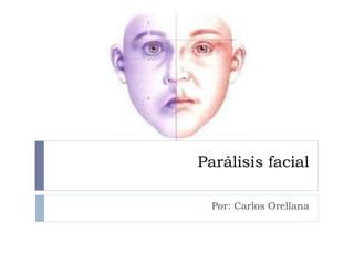 Parálisis facial
Por: Carlos Orellana
 