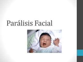 Parálisis Facial
 