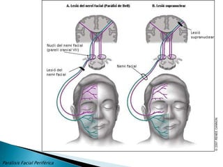 EXPLORACION DEL VII par.La exploración clínica funcional del nervio facial comprende cuatro vertientes: clínica, topográfica, eléctrica y diagnostico por la imagen. El conjunto de todas ellas permite además poder emitir un pronóstico sobre el grado de lesión y la evolución mas probable de la misma.Para poder entender las manifestaciones clínicas de la parálisis facial es obligatorio y fundamental conocer su fisiopatología.La severidad de la lesión fue clasificada por Seddon y Sunderland en cinco supuestos:NeuropraxiaAxonotmesisNeurotmesis que a su vez se divide en:EndoneurotmesisPerineurotmesisNeurotmesis completaParálisis Facial Periférica